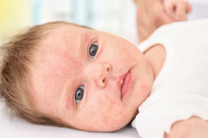 Baby Allergy Medicine: What’s Safe and When to Start // Healthier Baby Today