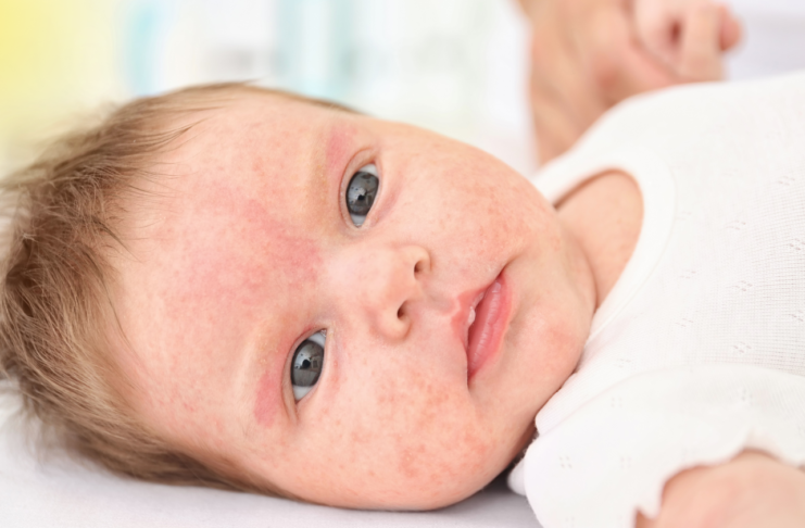 Baby Allergy Medicine: What’s Safe and When to Start // Healthier Baby Today