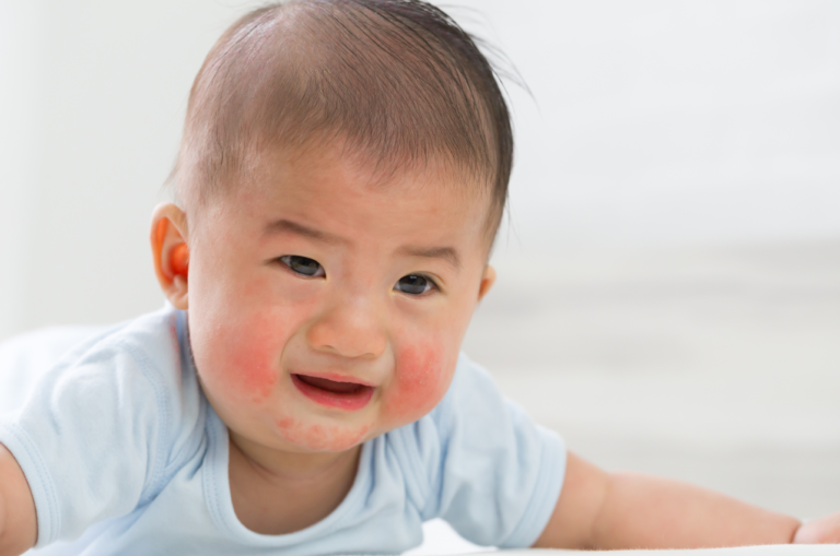 Infant Hives Explained: Why Is Your Baby Breaking Out in Hives? // Healthier Baby Today